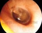 Bei gesunden Patienten ist beim Bilck in das Ohr, ein vollständig geschlossenes Trommelfell erkennbar
