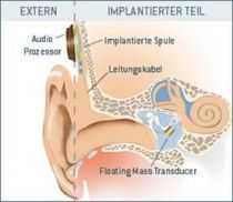 Bild zeigt Schema eines teilimplantierten Hörsystems mit externem Audioprozessor und dem eigentlichen Implantat