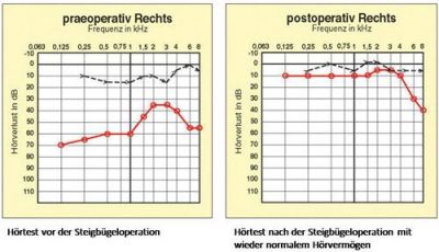 Hörverlust wird durch Eingriff deutlich minimiert. Bei tiefen Frequenzen beträgt er rund 10 dB (vorher rund 70 dB) und bei höheren nur mehr rund 5 dB (vorher zwischen 30 dB und 50 dB).